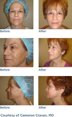 ActiveFX Before & After Photos
