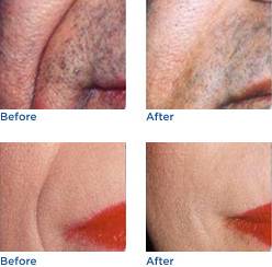 Artefill® Before & After Photos
