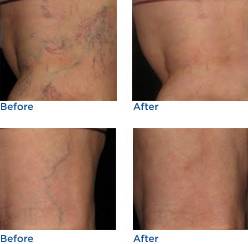 Asclera® Sclerotherapy Leg Vein Treatment Before & After Photos