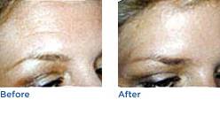 Botox® Before & After Photos