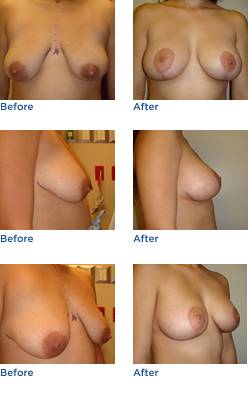 Breast Lift Austin Before & After Photos