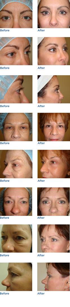 Eyelid Surgery (Blepharoplasty) Before & After Photos