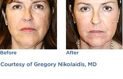 Fraxel Re:Pair™ Fractionated Resurfacing Before & After Photos