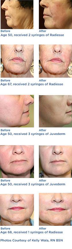 Injectable Thread Lift Before & After Photos