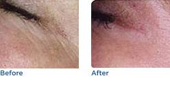 Photorejuvenation Before & After Photos