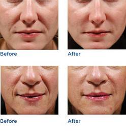 Juvederm® Austin Before & After Photos