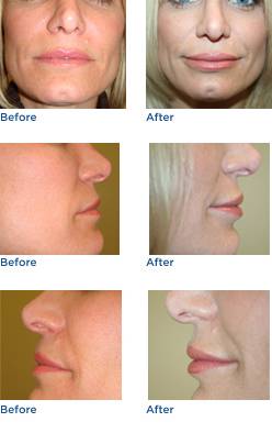 Lip Implant Surgery Before & After Photos