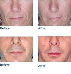 Radiesse® Dermal Filler Before & After Photos