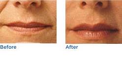 Restylane® Dermal Filler Before & After Photos