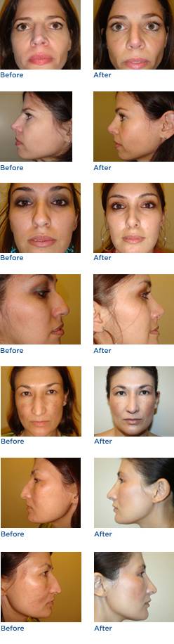 Rhinoplasty Austin Before & After Photos