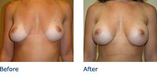 Patient A Silicone Before and After