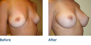 Patient A Silicone Before and After