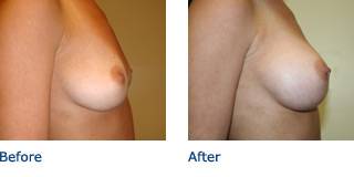 Patient A Silicone Before and After