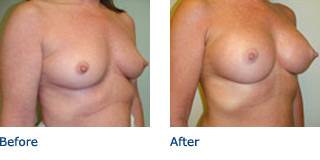 Patient B Silicone Before and After