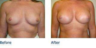 Patient B Silicone Before and After