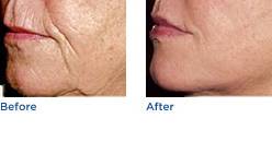 Sculptra Aesthetic Austin Before & After Photos