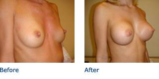 Patient A Silicone Before and After