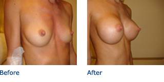 Patient A Silicone Before and After