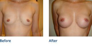 Patient B Silicone Before and After