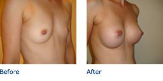 Patient B Silicone Before and After