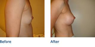 Patient B Silicone Before and After