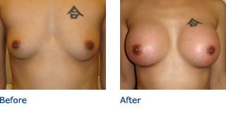 Patient C Silicone Before and After