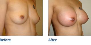 Patient C Silicone Before and After