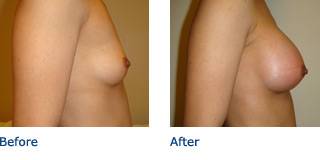 Patient C Silicone Before and After