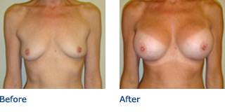 Patient D Silicone Before and After