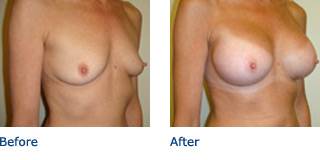 Patient D Silicone Before and After