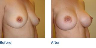 Patient E Silicone Before and After