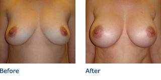 Patient E Silicone Before and After