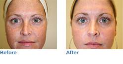 Skin Lightening System Before & After Photos