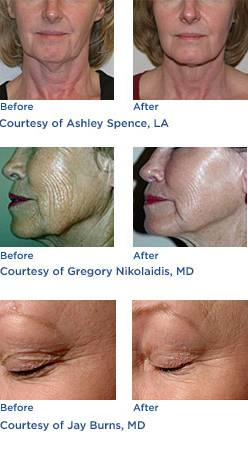 Thermage™ Skin Tightening Laser Before & After Photos