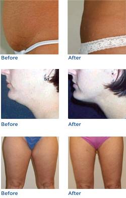 Tumescent Liposuction Before & After Photos