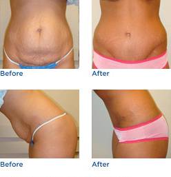 Tummy Tuck Before & After Photos