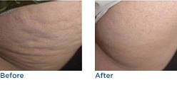 VelaSmooth™ Cellulite Laser Treatment Before & After Photos