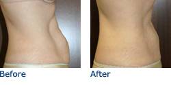 CoolSculpting® Austin Before & After Photos