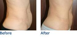 CoolSculpting® Austin Before & After Photos