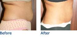 CoolSculpting® Austin Before & After Photos