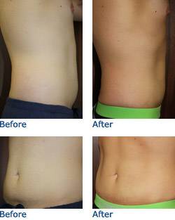 CoolSculpting® Austin Before & After Photos