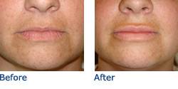Lip Implant Surgery Before & After Photos