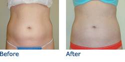 SmartLipo Austin Before & After Photos