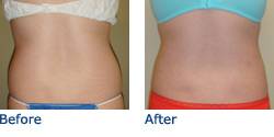 SmartLipo Austin Before & After Photos