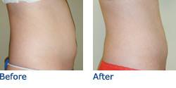 SmartLipo Austin Before & After Photos