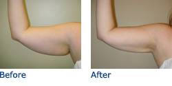 SmartLipo Austin Before & After Photos