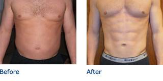 SmartLipo Austin Before & After Photos