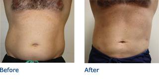 SmartLipo Austin Before & After Photos