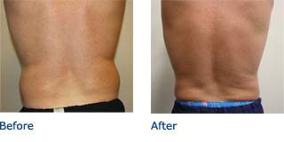 SmartLipo Austin Before & After Photos