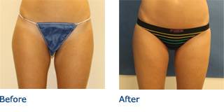 SmartLipo Austin Before & After Photos